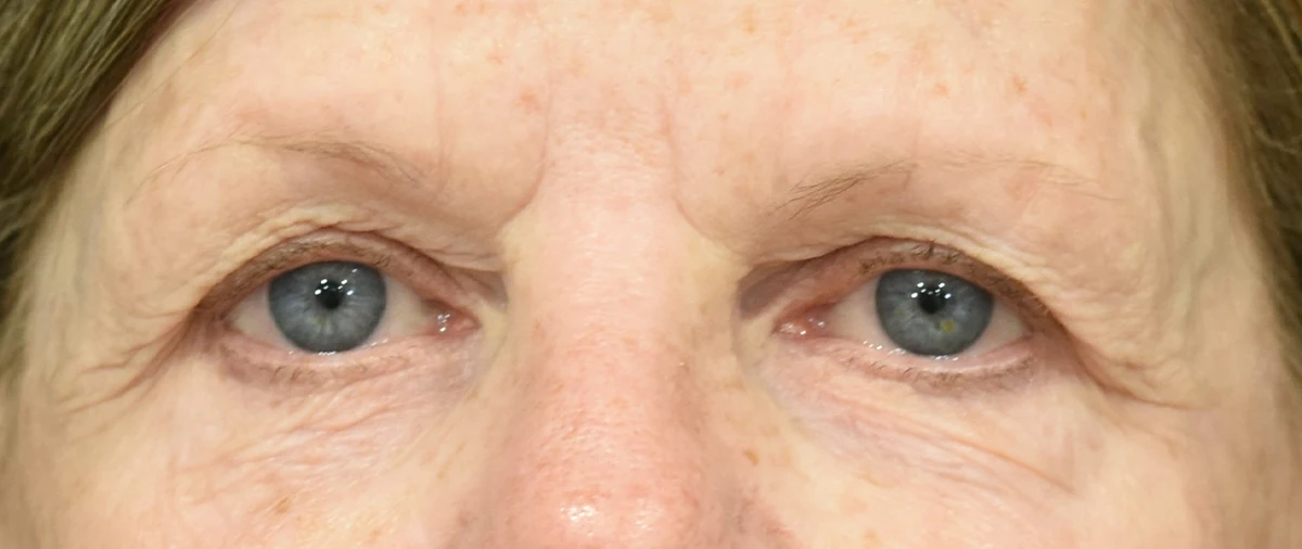 Eyelid Surgery Patient 18 - Set 1 - Before